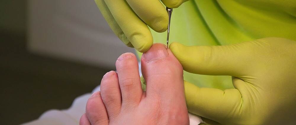 临床试验使用糖尿病患者自身细胞治愈糖尿病足伤口