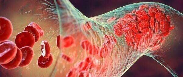 研究：女性糖尿病人患静脉血栓栓塞症的风险更高