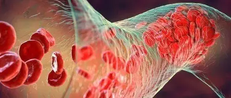 研究:女性糖尿病人患静脉血栓栓塞症的风险更高