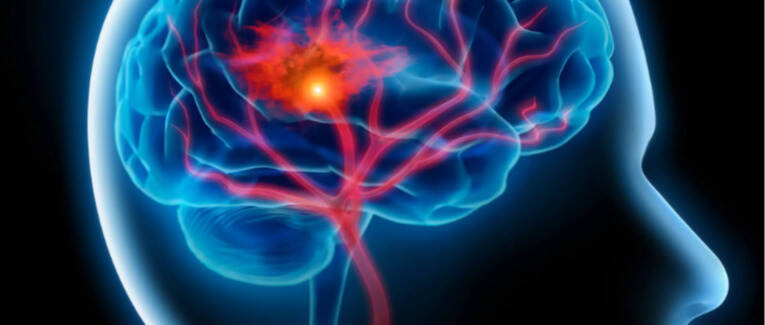 糖尿病人如何降低中风风险