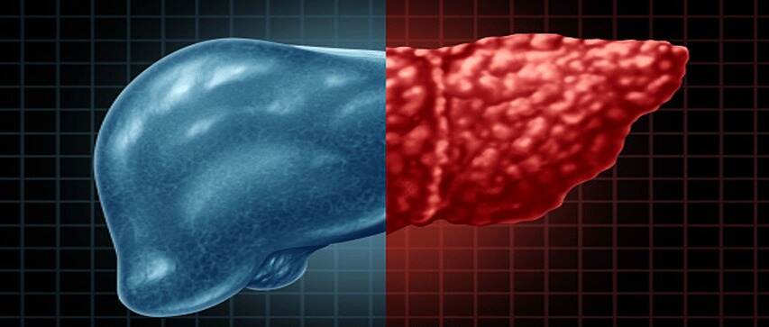 研究：脂肪肝可能是引起2型糖尿病的重要因素