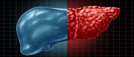 研究:脂肪肝可能是引起2型糖尿病的重要因素 研究:脂肪肝可能是引起2型糖尿病的重要因素