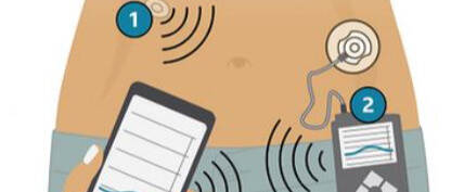 人造胰腺给1型糖尿病患者带来的喜悦和希望