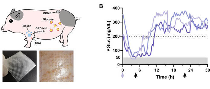 研究：可根据血糖水平进行自我调节胰岛素供应量的微针贴剂